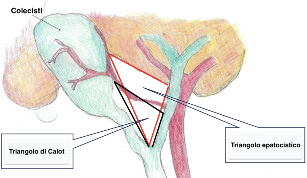 Schema del Critical View of Safety (CVS) durante la colecistectomia laparoscopica, che mostra la corretta identificazione del dotto cistico e dell'arteria cistica prima della loro sezione per ridurre il rischio di lesioni delle vie biliari.